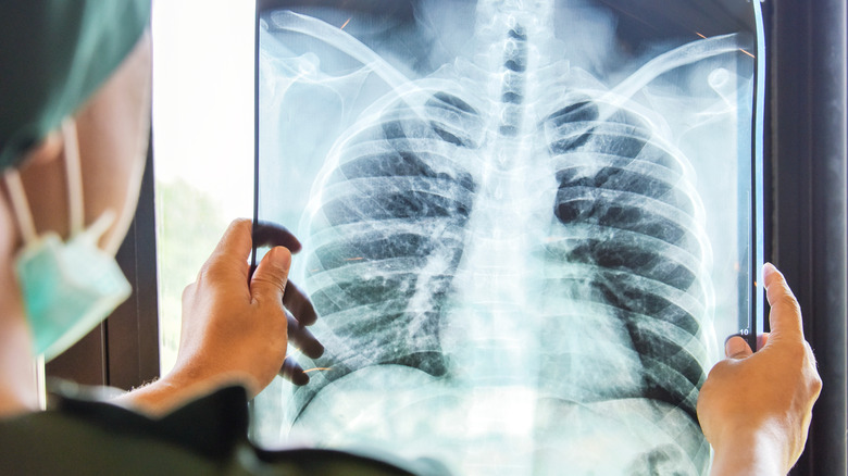 doctor holding chest X-ray