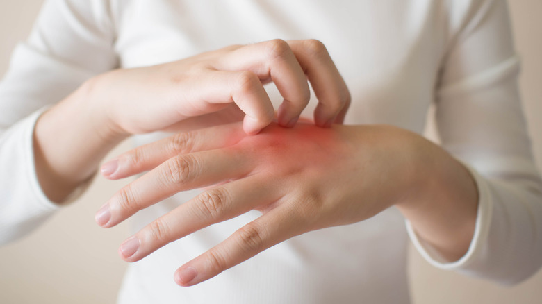 woman scratching a rash on her hand