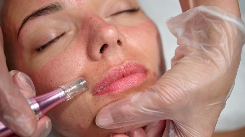 Woman getting microneedling treatment