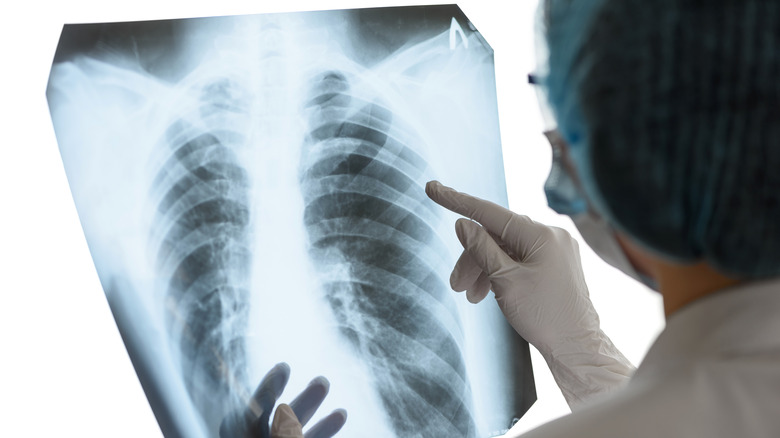 doctor looking at chest x-ray