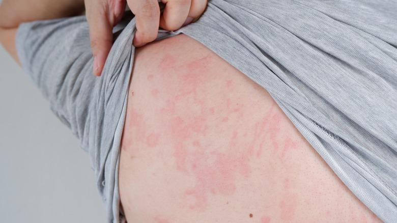 man with hives on his back