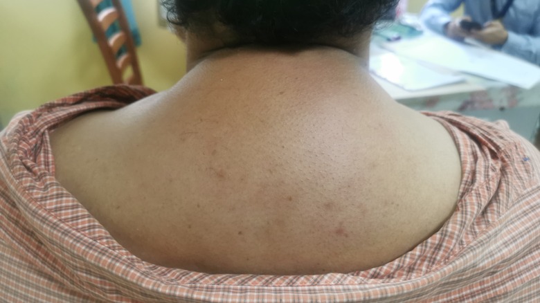 a patient with buffalo hump caused by cushing syndrome