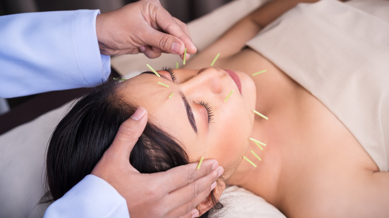 a woman getting acupuncture 
