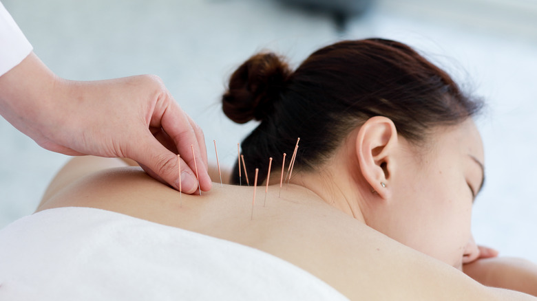 acupuncture on woman's back