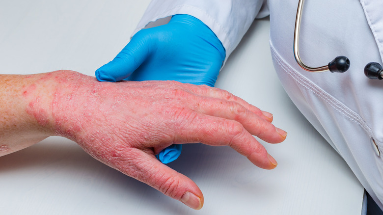 doctor examining patient's hand with psoriasis