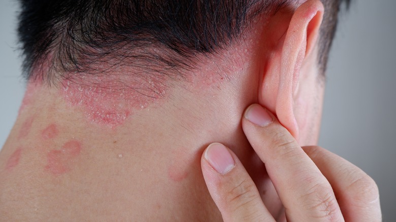 psoriasis on nape of the neck
