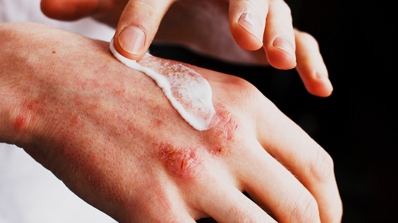 man applying topical medication on psoriasis