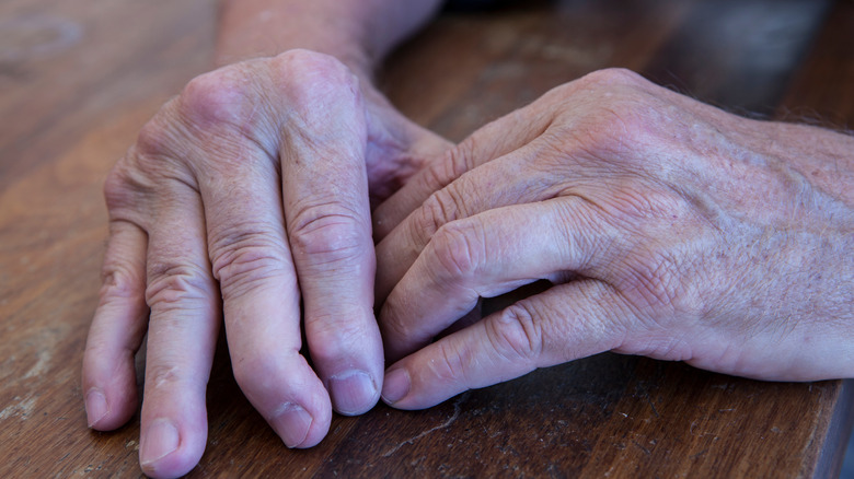 man's hands affected by psoriatic arthritis