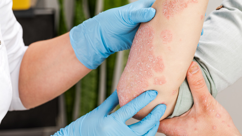 doctor examining psoriasis on forearm