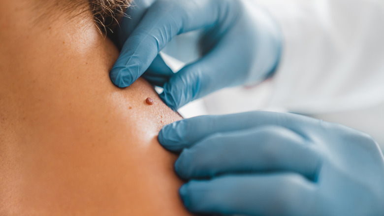 dermatologist examining mole