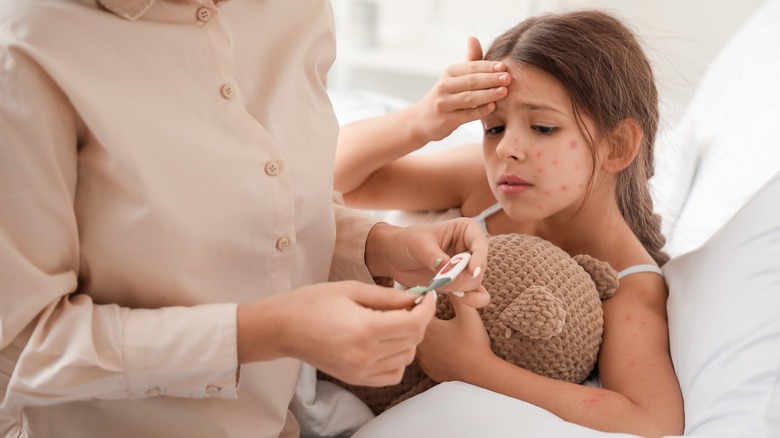 Child with chickenpox looks at thermometer