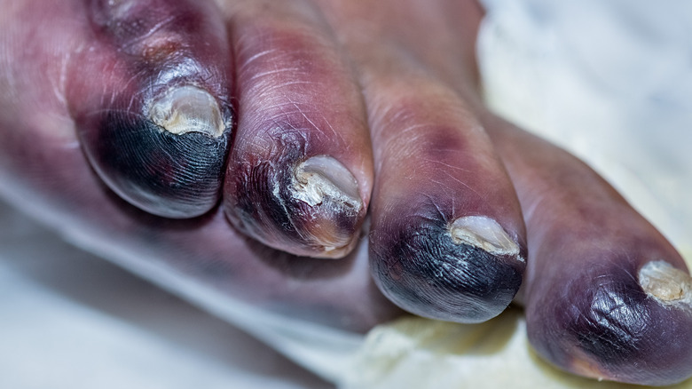 severe gangrene in toes