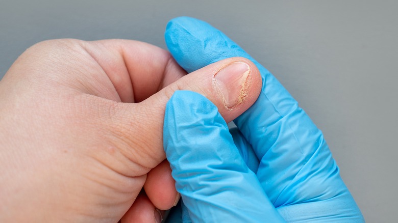 doctor examines condition of fingernail