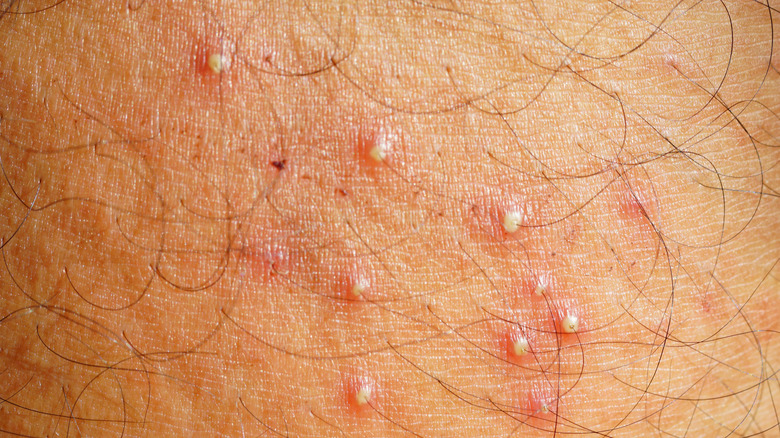 Close up of the skin condition folliculitis 