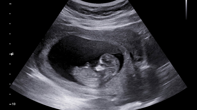 Ultrasound of baby in uterus