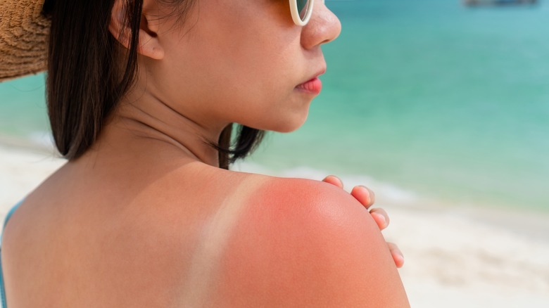 woman with sunburn on shoulder