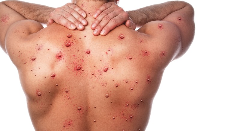 man with pimples on the back