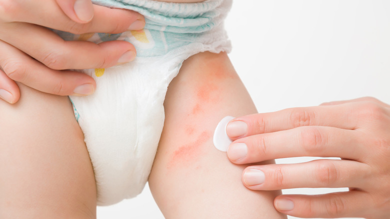 hand applying ointment on toddler