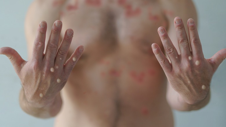 man with spots on hands