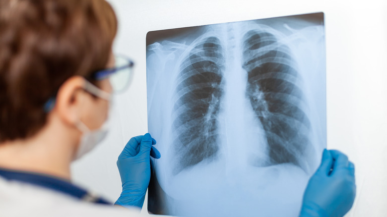 Doctor holding lung x-ray
