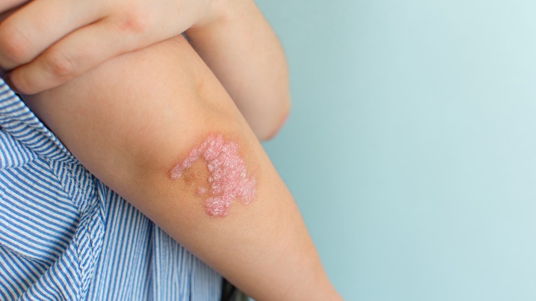 Psoriasis on elbow