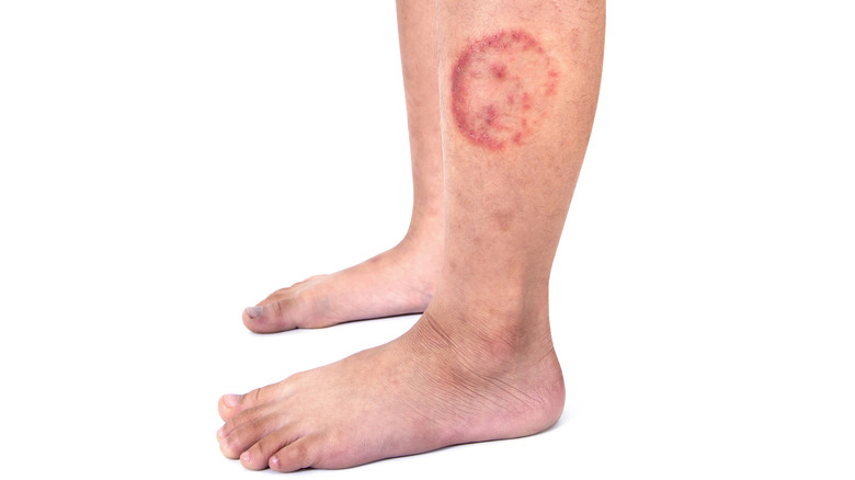 Close up image of ringworm lesion on leg