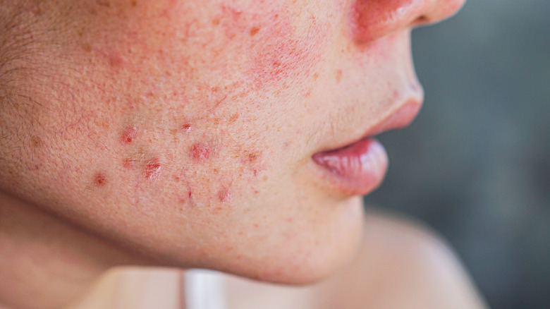 close up profile of acne rosacea on female