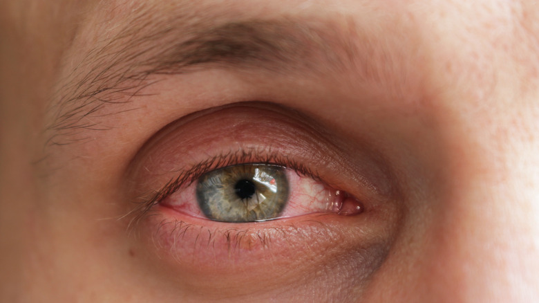 close up of man's red, irritated, swollen eye
