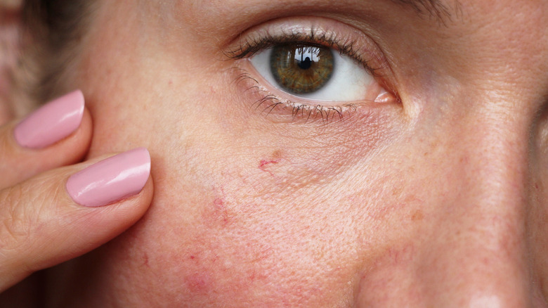 spider veins on face