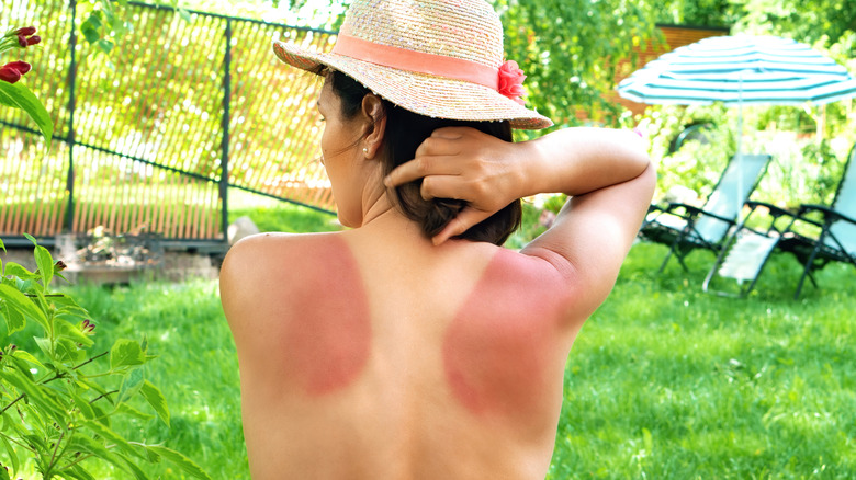 Sunburned skin