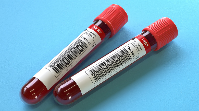 Two vials of blood samples