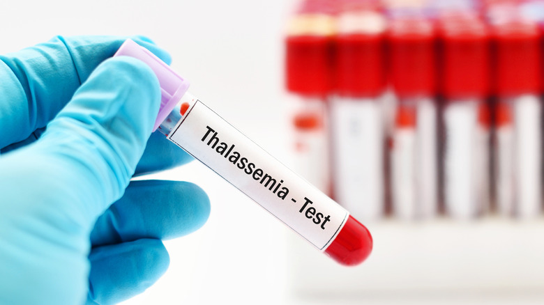 Vial of blood labeled thalassemia