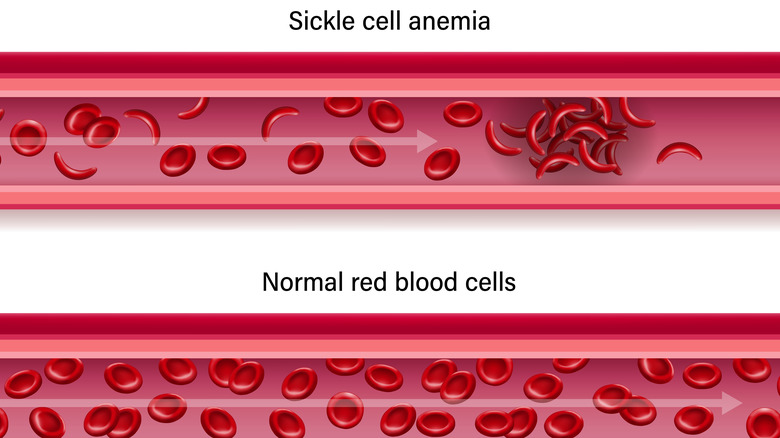 Illustration comparing normal and sickled red blood cells