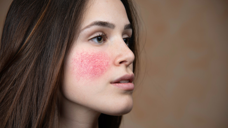 woman with rosacea