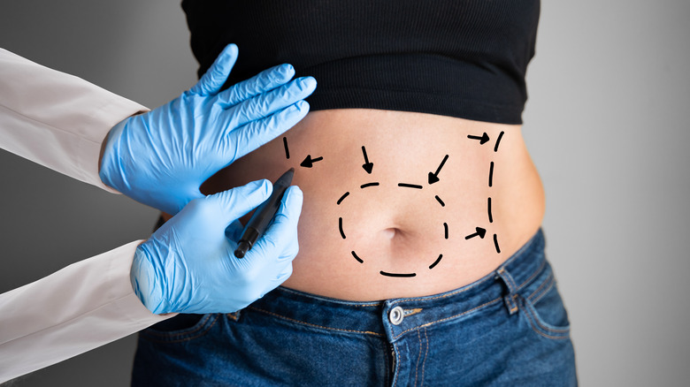 liposuction preparations