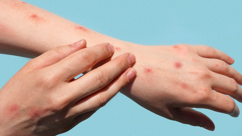 close up of rash in hands and arms