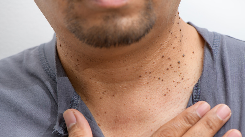 skin tags on neck of man