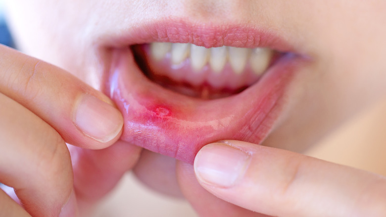 canker sore on lip