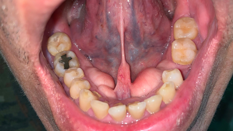 lumps on lower gum