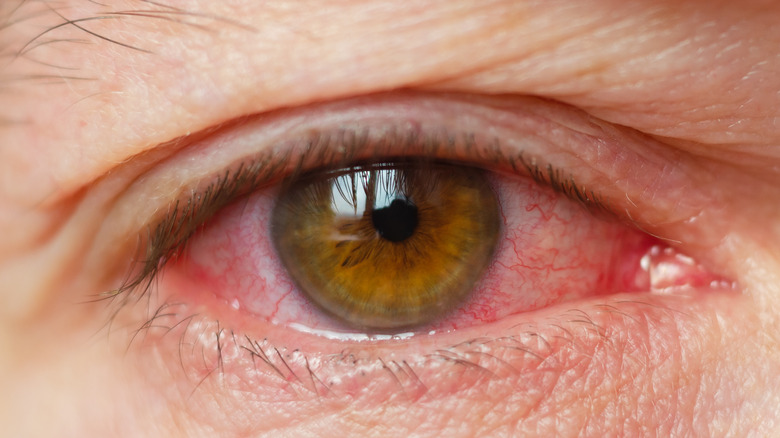 person with conjunctivitis in eye