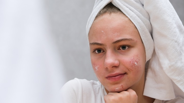 woman experiencing breakouts on face