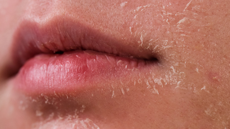 dry skin around lips