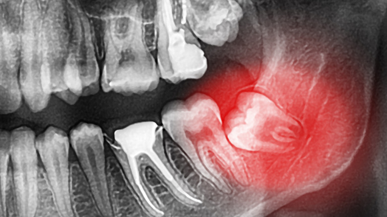 x-ray of wisdom tooth