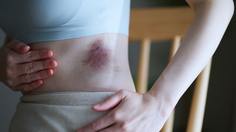 Woman with a bruise