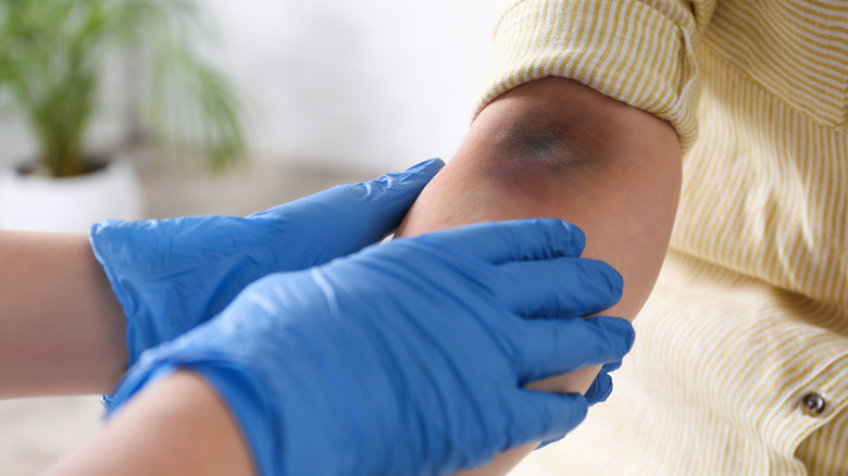 Woman having a bruise checked