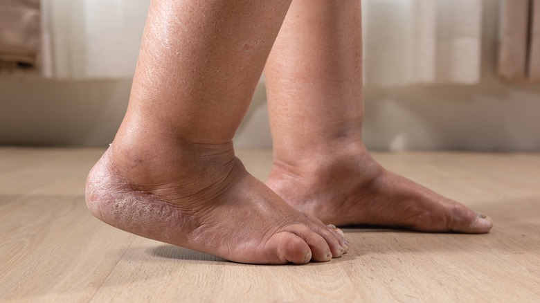 https://www.healthdigest.com/img/gallery/signs-your-swollen-feet-might-require-a-trip-to-the-doctor/intro-1696859679.jpg