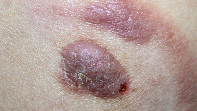 cutaneous T-cell lymphoma