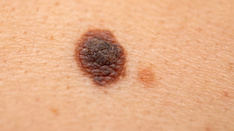 melanoma