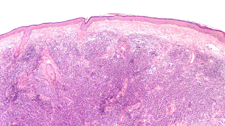 merkel cell carcinoma