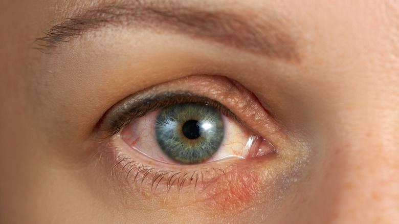 eyelid tumor